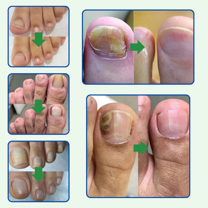 Aceite Novapure. Resultados en tan solo 7-10 dias.